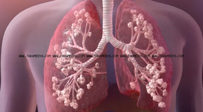 Koronavirüs sürecinde Kistik Fibrozis hastaları büyük risk altında! 
